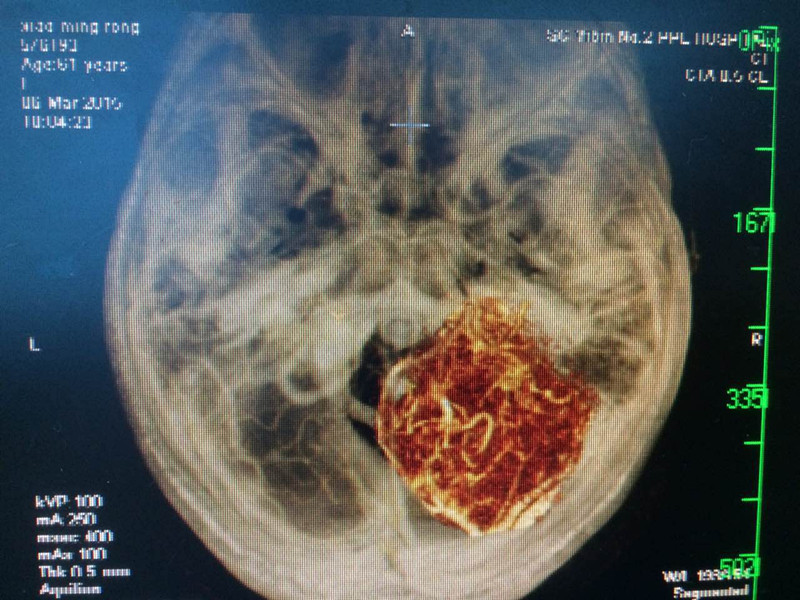 我科应用无水乙醇+美兰瘤内注射示踪止血技术完成1例CPA区巨大高血运脑膜瘤手术