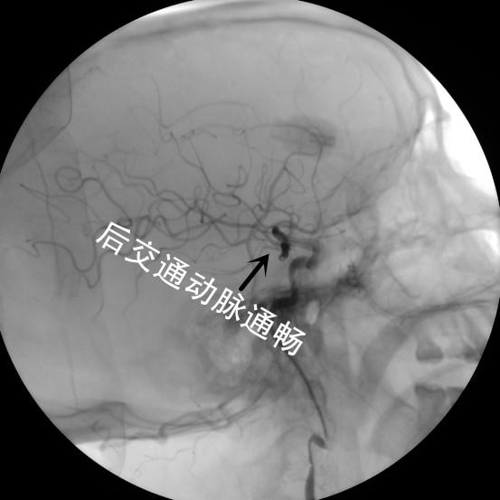 我科采用Lvis支架半释放技术完成复杂后交通动脉瘤介入治疗
