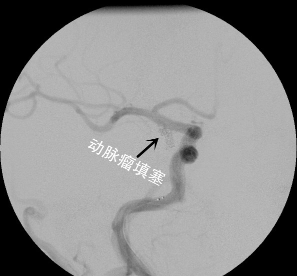 我科采用Lvis支架半释放技术完成复杂后交通动脉瘤介入治疗