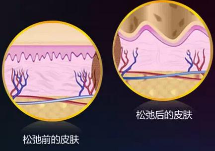 2017年新一代无创紧肤除皱领域新热点—ThermoLift热拉提