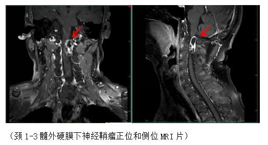 颈子肩膀又麻又痛，竟是颈椎里长了肿瘤？！