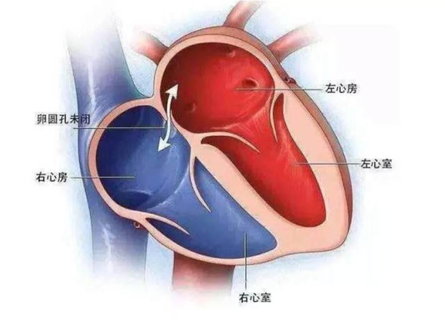 “心”洞一堵“脑”症消失——宜宾首例卵圆孔未闭封堵术治疗不明原因脑卒中及头痛在我院成功开展