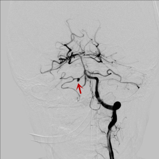 我科完成一例小脑前下动脉 (AICA )动脉瘤介入治疗