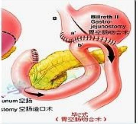 毕II式胃大部切除 胃空肠吻合示意图