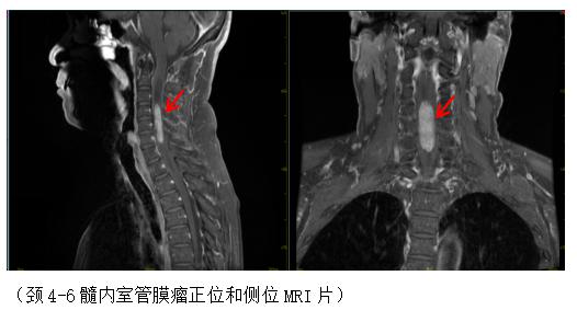 颈子肩膀又麻又痛，竟是颈椎里长了肿瘤？！