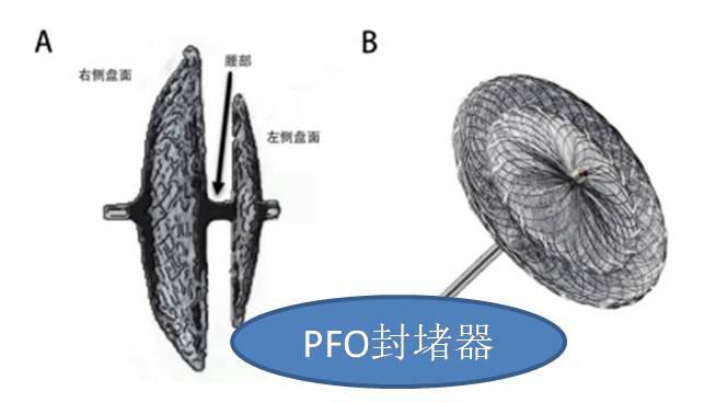 “心”洞一堵“脑”症消失——宜宾首例卵圆孔未闭封堵术治疗不明原因脑卒中及头痛在我院成功开展