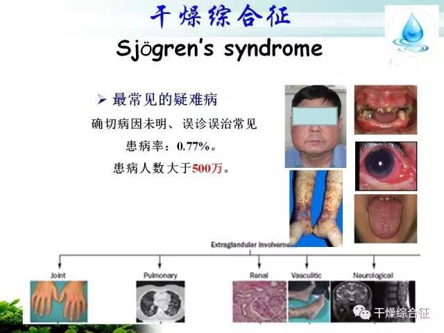 秋风起，口干、眼干，警惕风湿免      疫科常见病-干燥综合征！