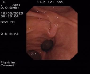 ①十二指肠镜探查肠腔，见十二指肠乳头旁憩室，增加插管难度